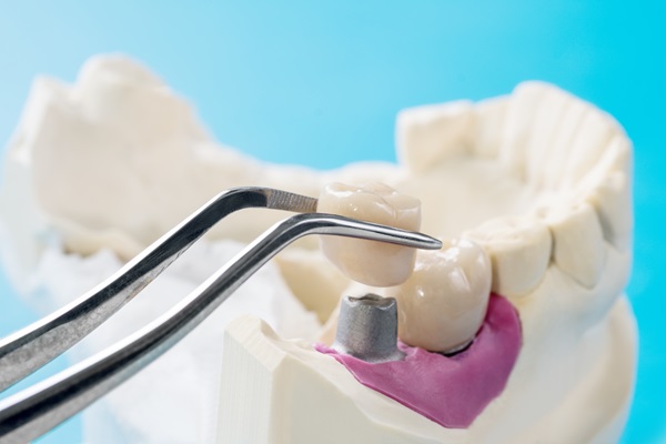 Can A General Dentist Repair A Dental Implant Restoration?