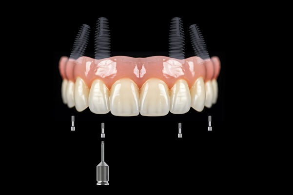 Implant Supported Dentures: Reasons To Consider All On